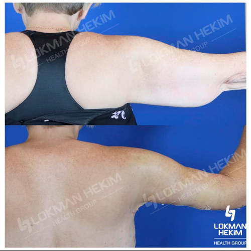 Брахиопластика Фотографии до и после